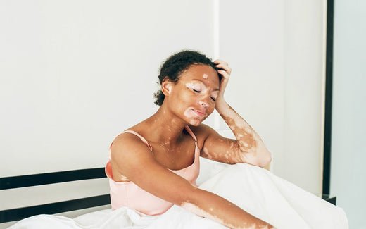 Woman with vitiligo in a pink top, eyes closed, hand on head, in bed